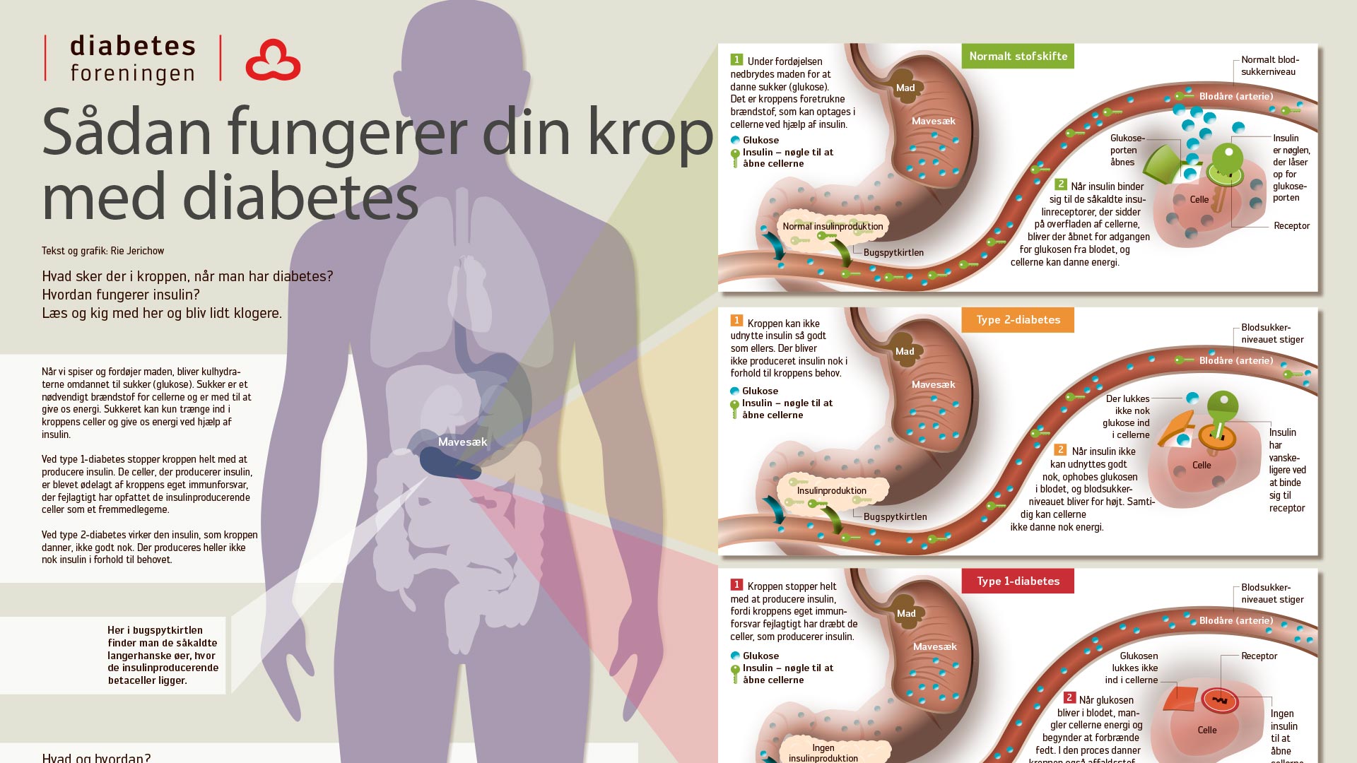 Fakta Om Diabetes 1 | Hvad Er Type 1-diabetes?